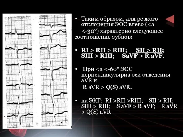 Таким образом, для резкого отклонения ЭОС влево ( RI > RII