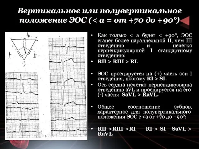 Вертикальное или полу­вертикальное положение ЭОС ( Как только RII > RIII