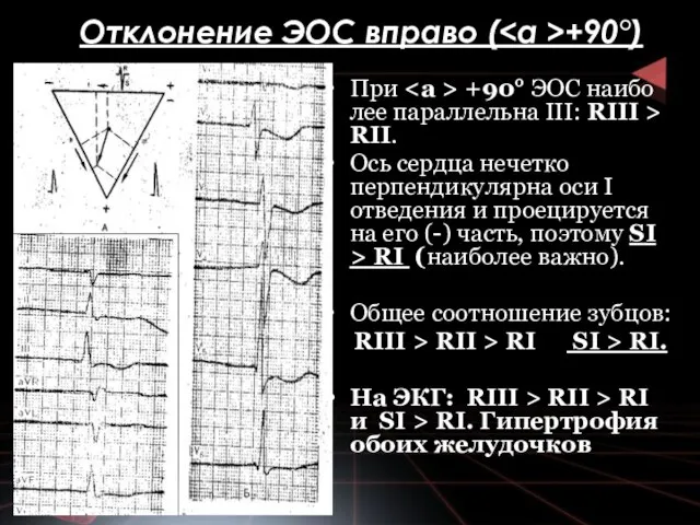 Отклонение ЭОС впра­во ( +90°) При +90° ЭОС наибо­лее параллельна III: