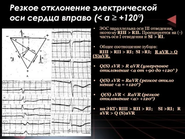 Резкое отклонение электрической оси серд­ца вправо ( ЭОС параллельна оси III