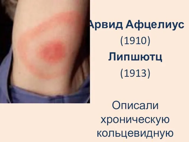 Арвид Афцелиус (1910) Липшютц (1913) Описали хроническую кольцевидную мигрирующую эритему на месте укуса клеща