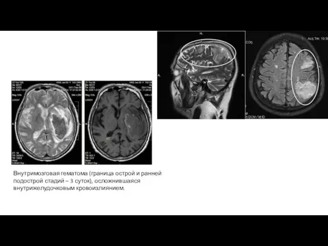 Внутримозговая гематома (граница острой и ранней подострой стадий – 3 суток), осложнившаяся внутрижелудочковым кровоизлиянием.