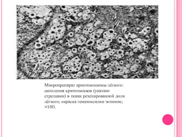 Микропрепарат криптококкомы лёгкого: скопления криптококков (указано стрелками) в ткани резецированной доли лёгкого; окраска гематоксилин-эозином; ×160.