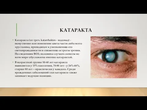 КАТАРАКТА Катаракта (от греч. katarrhaktes - водопад) - помутнение или изменение