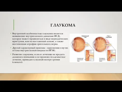 ГЛАУКОМА Внутренней особенностью глаукомы является повышение внутриглазного давления (ВГД), которое может