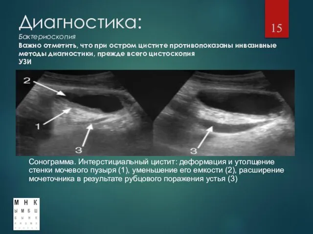 Диагностика: Бактериоскопия Важно отметить, что при остром цистите противопоказаны инвазивные методы