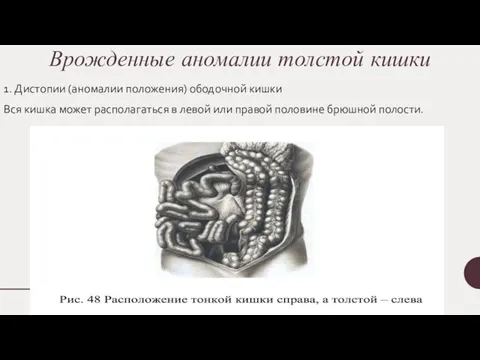 Врожденные аномалии толстой кишки 1. Дистопии (аномалии положения) ободочной кишки Вся