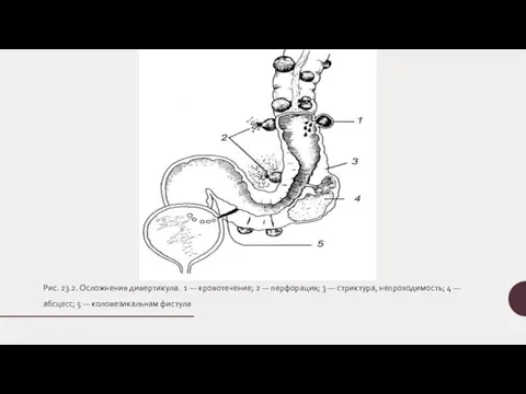 Рис. 23.2. Осложнения дивертикула. 1 — кровотечение; 2 — перфорация; 3