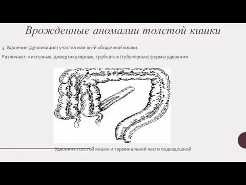 Врожденные аномалии толстой кишки 3. Удвоение (дупликация) участка или всей ободочной