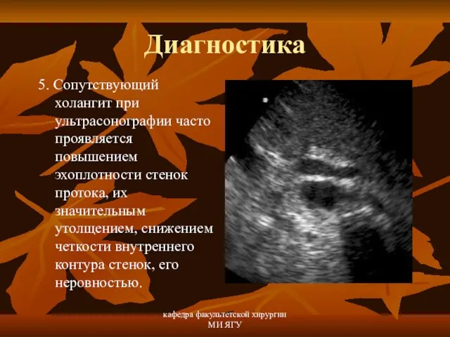 кафедра факультетской хирургии МИ ЯГУ Диагностика 5. Сопутствующий холангит при ультрасонографии