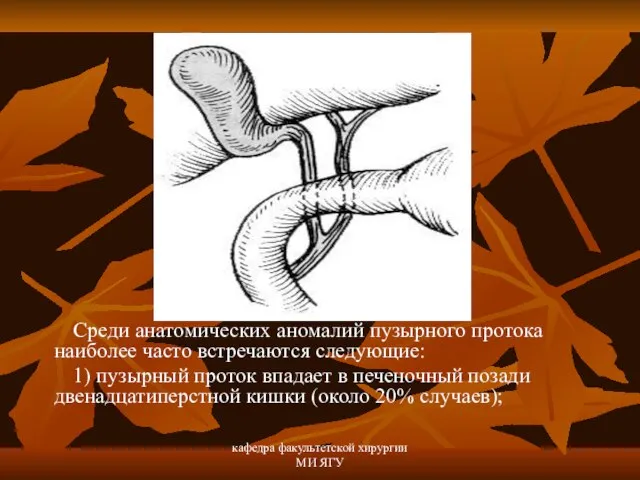 кафедра факультетской хирургии МИ ЯГУ Среди анатомических аномалий пузырного протока наиболее