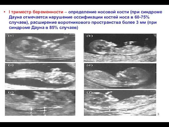 I триместр беременности – определение носовой кости (при синдроме Дауна отмечается