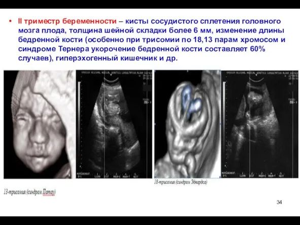 II триместр беременности – кисты сосудистого сплетения головного мозга плода, толщина