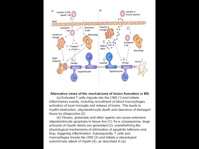 Alternative views of the mechanisms of lesion formation in MS. (a)