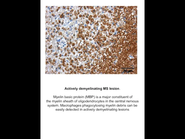 Actively demyelinating MS lesion. Myelin basic protein (MBP) is a major