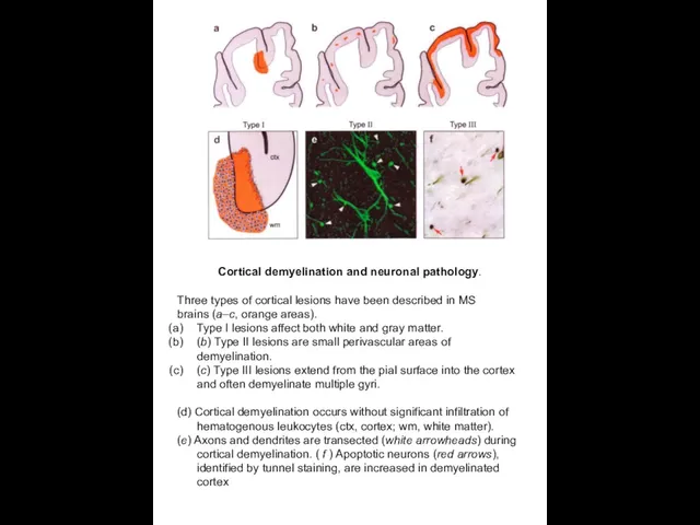 Cortical demyelination and neuronal pathology. Three types of cortical lesions have