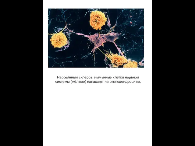 Рассеянный склероз: иммунные клетки нервной системы (жёлтые) нападают на олигодендроциты,