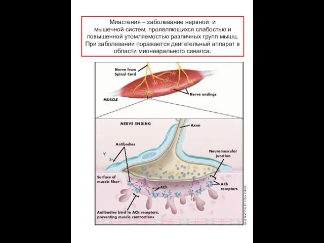 Миастения – заболевание нервной и мышечной систем, проявляющихся слабостью и повышенной