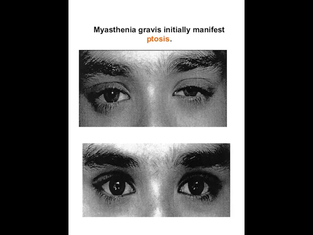 Myasthenia gravis initially manifest ptosis.