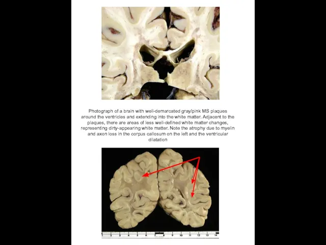 Photograph of a brain with well-demarcated gray/pink MS plaques around the