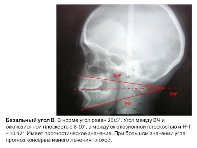 Базальный угол В. В норме угол равен 20±5°. Угол между ВЧ