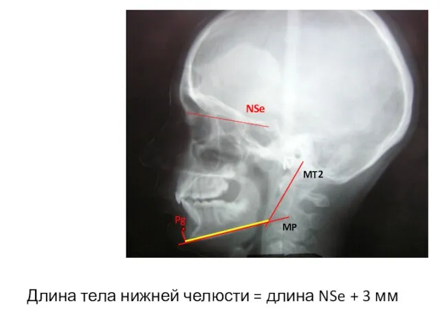 Длина тела нижней челюсти = длина NSe + 3 мм Pg MP MT2 NSe