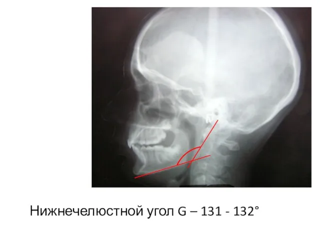 Нижнечелюстной угол G – 131 - 132°