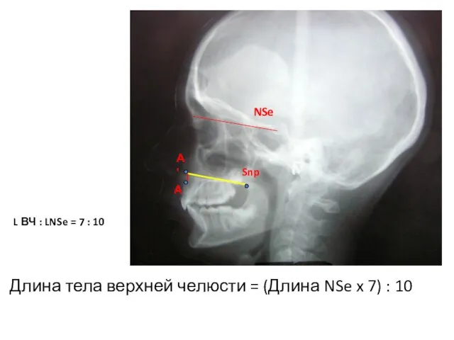 Длина тела верхней челюсти = (Длина NSe x 7) : 10