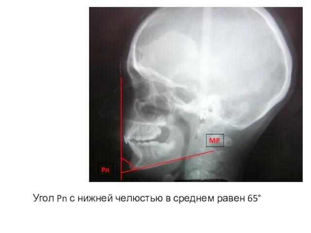 Угол Pn с нижней челюстью в среднем равен 65° Pn MP