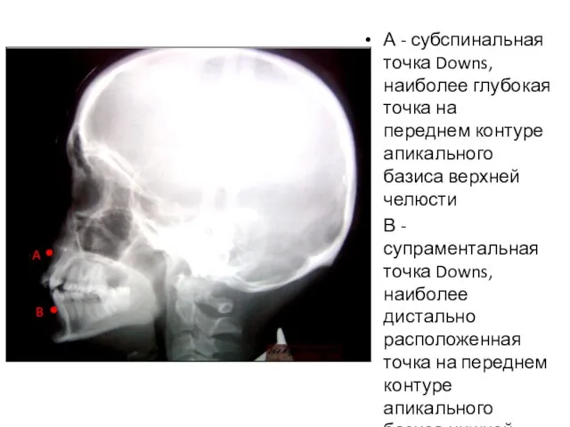 А - субспинальная точка Downs, наиболее глубокая точка на переднем контуре