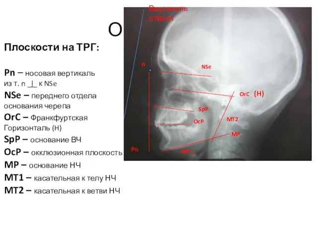 Ориентиры n NSe Pn OrC SpP OcP MT1 MT2 MP Вертикаль