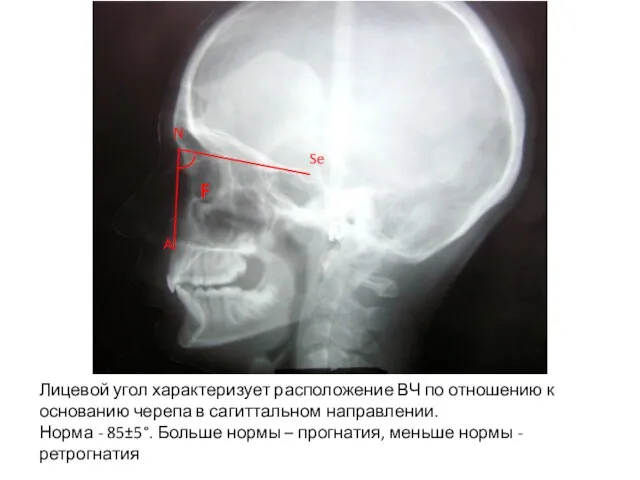 Лицевой угол характеризует расположение ВЧ по отношению к основанию черепа в