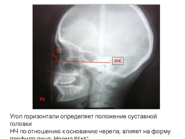 Угол горизонтали определяет положение суставной головки НЧ по отношению к основанию