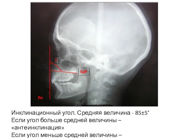 Инклинационный угол. Средняя величина - 85±5° Если угол больше средней величины