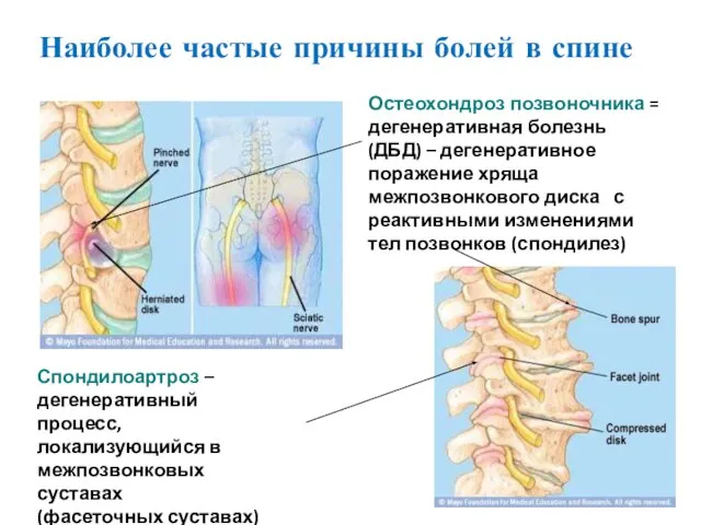 Остеохондроз позвоночника = дегенеративная болезнь (ДБД) – дегенеративное поражение хряща межпозвонкового