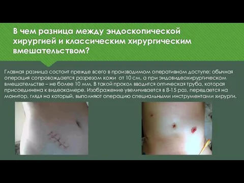 В чем разница между эндоскопической хирургией и классическим хирургическим вмешательством? Главная