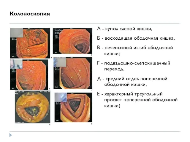 Колоноскопия А - купол слепой кишки, Б - восходящая ободочная кишка,