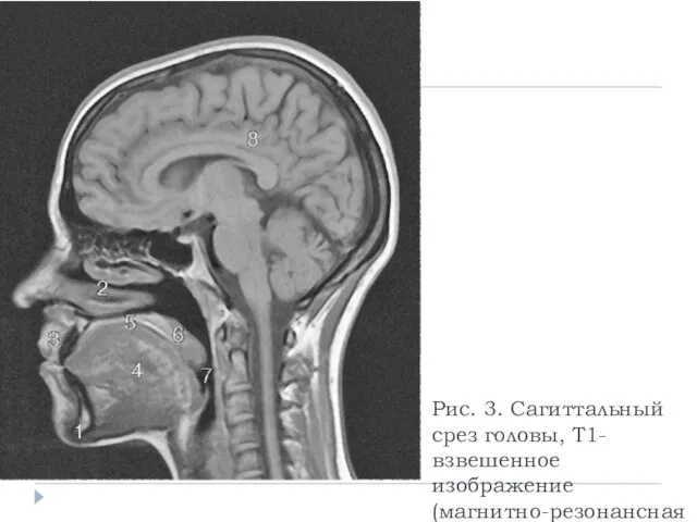 Рис. 3. Сагиттальный срез головы, Т1-взвешенное изображение (магнитно-резонансная томография): 1 -