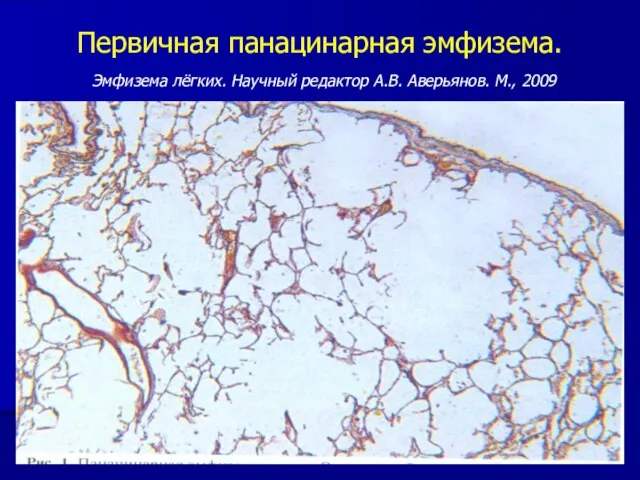 Первичная панацинарная эмфизема. Эмфизема лёгких. Научный редактор А.В. Аверьянов. М., 2009