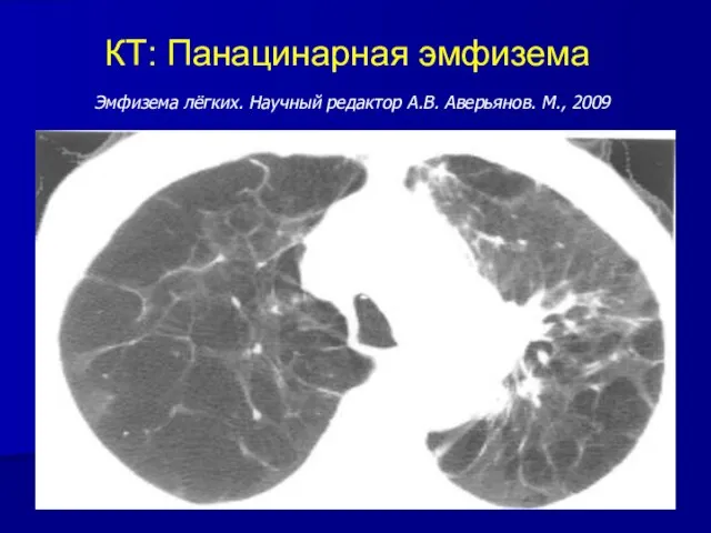 КТ: Панацинарная эмфизема Эмфизема лёгких. Научный редактор А.В. Аверьянов. М., 2009