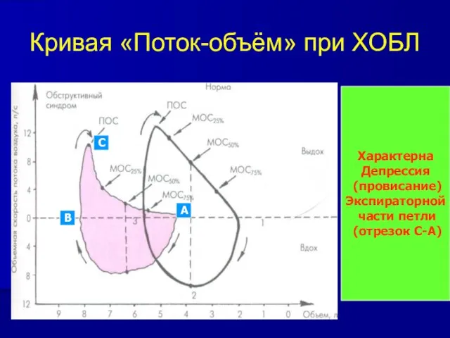 Кривая «Поток-объём» при ХОБЛ Характерна Депрессия (провисание) Экспираторной части петли (отрезок С-А) С А В