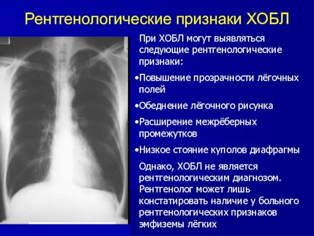 Рентгенологические признаки ХОБЛ При ХОБЛ могут выявляться следующие рентгенологические признаки: Повышение