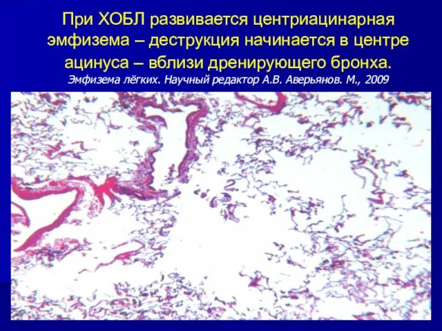 При ХОБЛ развивается центриацинарная эмфизема – деструкция начинается в центре ацинуса