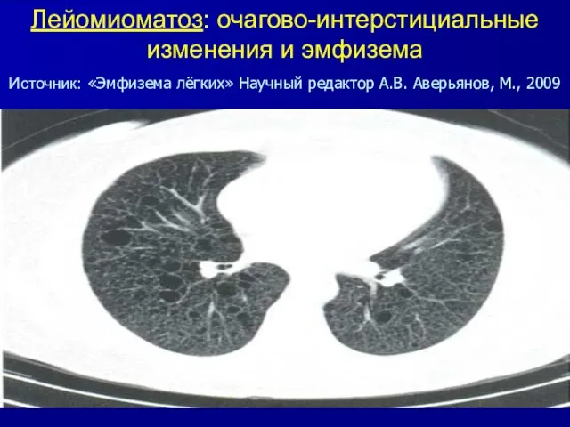 Лейомиоматоз: очагово-интерстициальные изменения и эмфизема Источник: «Эмфизема лёгких» Научный редактор А.В. Аверьянов, М., 2009