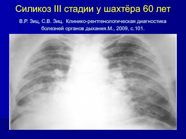 Силикоз III стадии у шахтёра 60 лет В.Р. Зиц, С.В. Зиц.