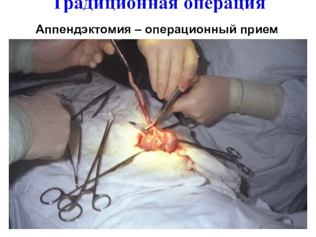 Традиционная операция Аппендэктомия – операционный прием
