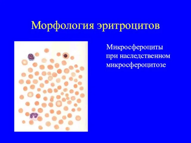 Морфология эритроцитов Микросфероциты при наследственном микросфероцитозе