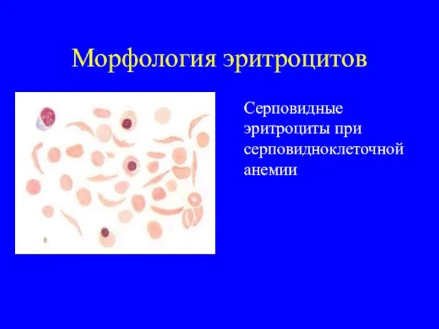 Морфология эритроцитов Серповидные эритроциты при серповидноклеточной анемии