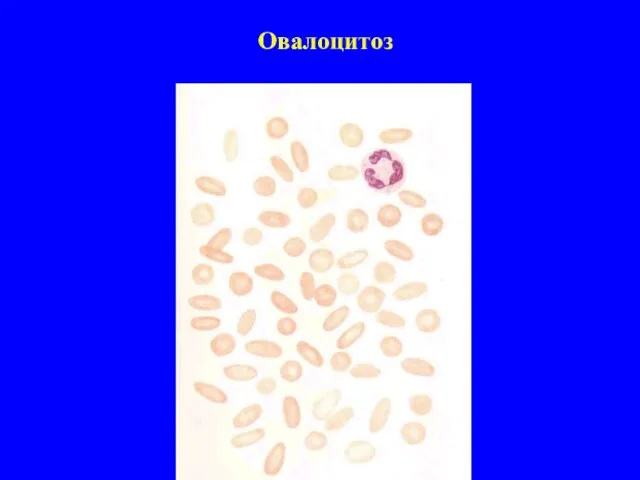 Овалоцитоз