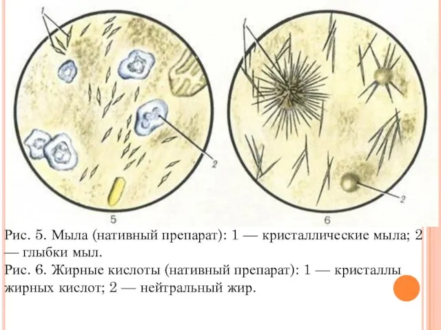 Рис. 5. Мыла (нативный препарат): 1 — кристаллические мыла; 2 —